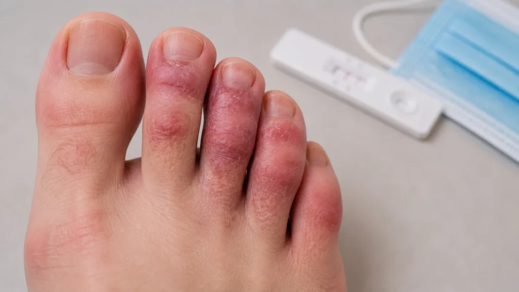 COVID Toes Symptoms, Causes & Treatment Options